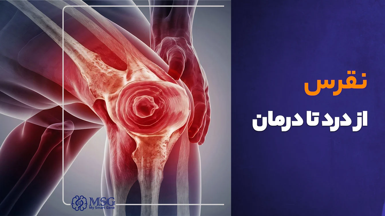 بیماری نقرس؛ از درد تا درمان